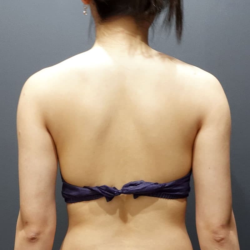 20240728_G28556_takemura_arm-liposuction①After