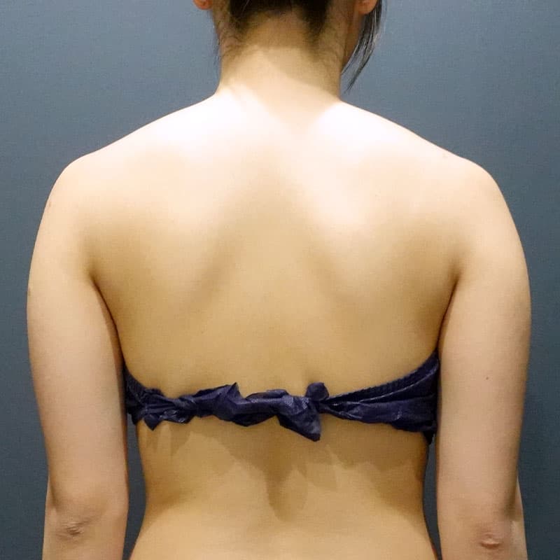 20240728_G28556_takemura_arm-liposuction①Before