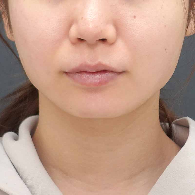 20240830_N48195_hurumura_face-liposuction_philtrum-botox②After