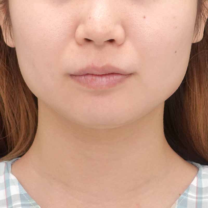 20240830_N48195_hurumura_face-liposuction_philtrum-botox②Before