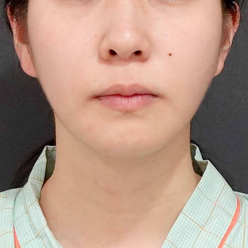 20240919_G18827_sato_face-liposuction_philtrum-botox①After