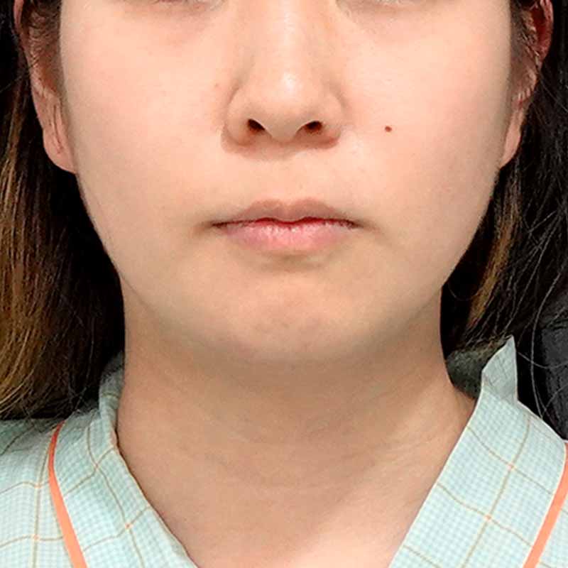 20240919_G18827_sato_face-liposuction_philtrum-botox①Before