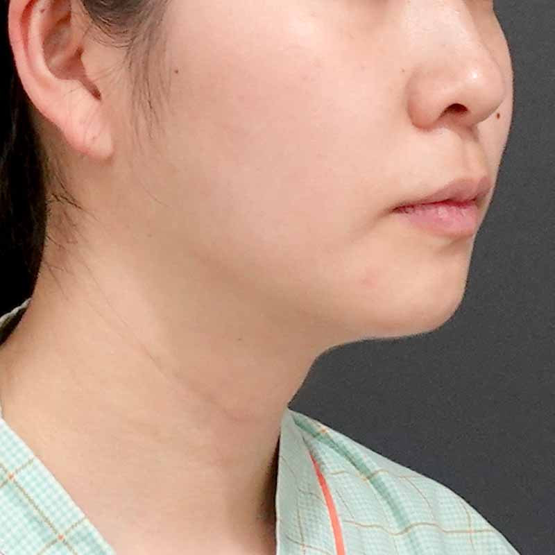 20240919_G18827_sato_face-liposuction_philtrum-botox②After