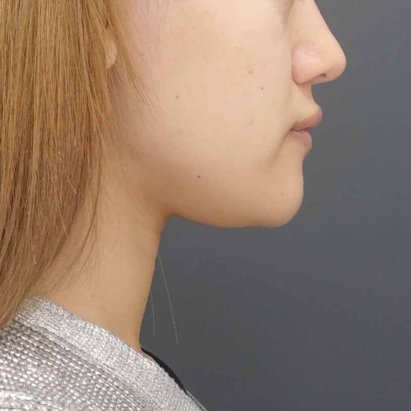 20240919_N34545_nisikawa_face-liposuction_philtrum-botox②After