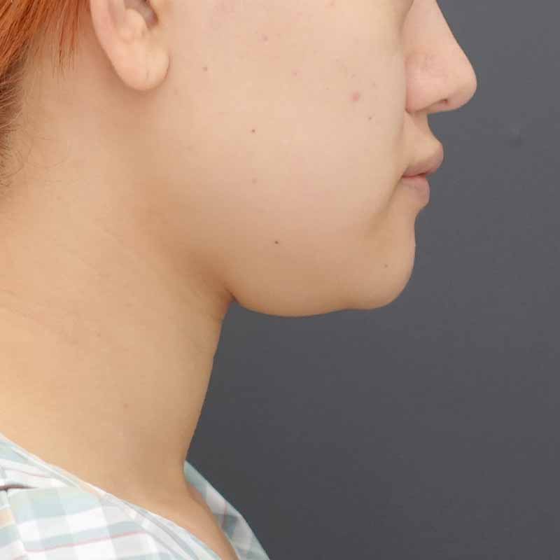 20240919_N34545_nisikawa_face-liposuction_philtrum-botox②Before