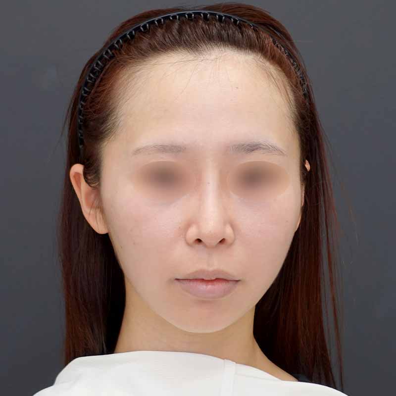 20240919_N39987_nisikawa_face-liposuction_philtrum-botox①After