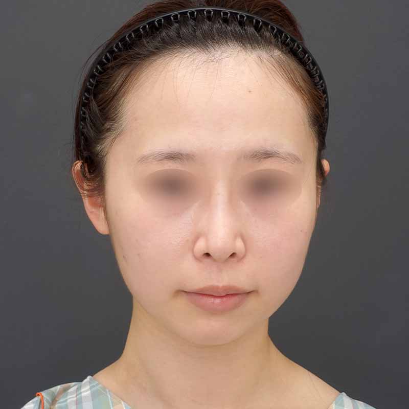 20240919_N39987_nisikawa_face-liposuction_philtrum-botox①Before