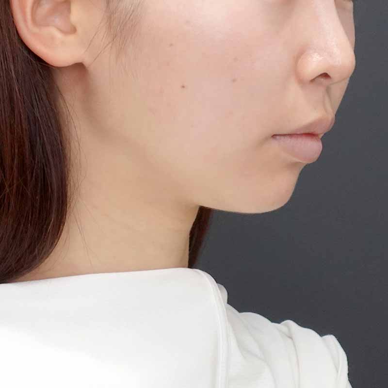 20240919_N39987_nisikawa_face-liposuction_philtrum-botox②After