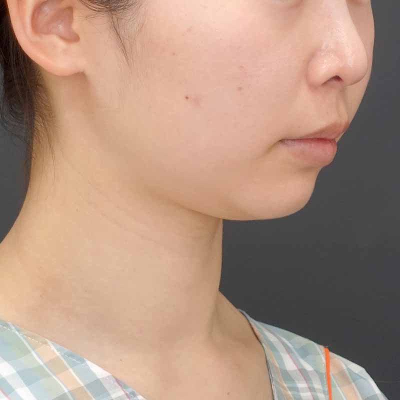 20240919_N39987_nisikawa_face-liposuction_philtrum-botox②Before