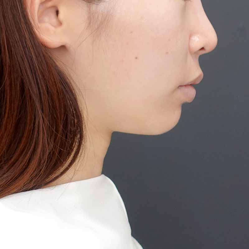 20240919_N39987_nisikawa_face-liposuction_philtrum-botox③After