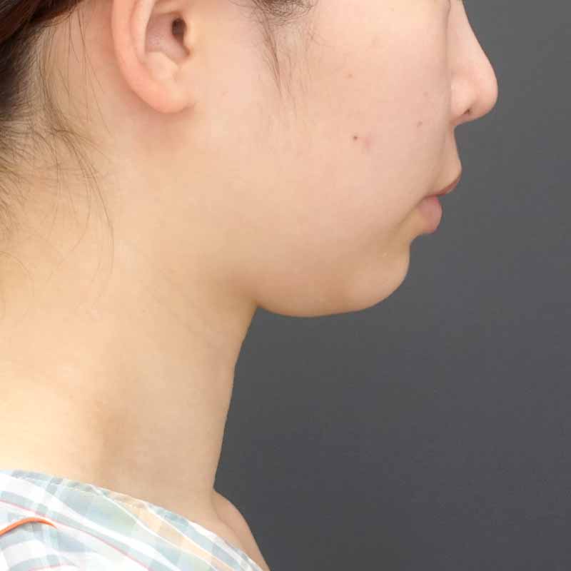 20240919_N39987_nisikawa_face-liposuction_philtrum-botox③Before