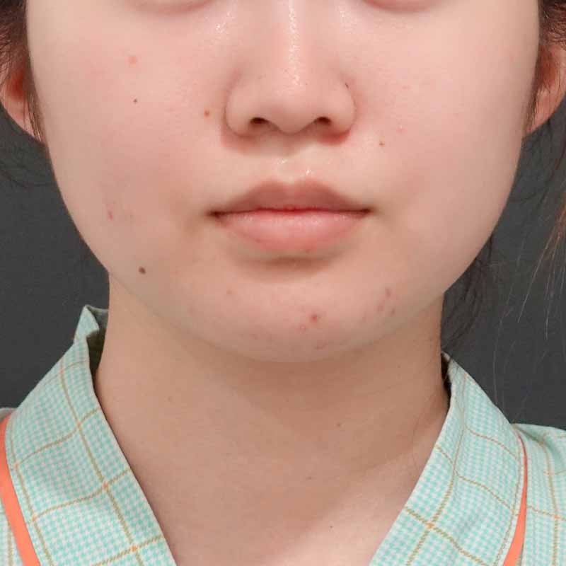 20240919_O-13236_sato_face-liposuction_philtrum-botox①Before