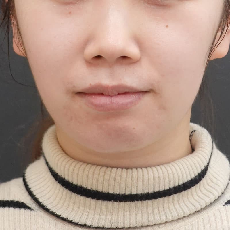 20241008_Fｰ1238_kaneko_face-liposuction_philtrum-botox①After