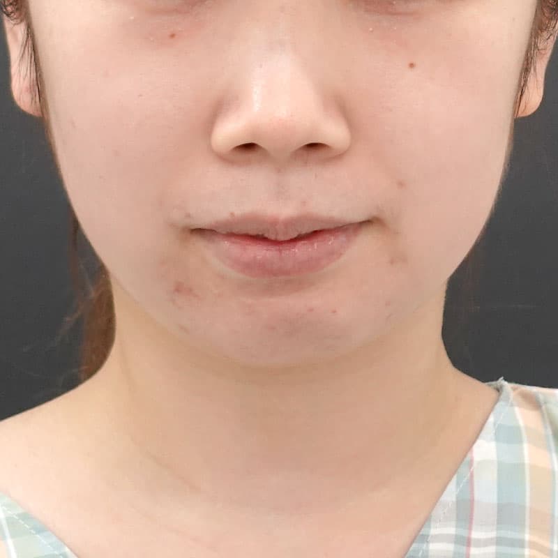 20241008_Fｰ1238_kaneko_face-liposuction_philtrum-botox①Before