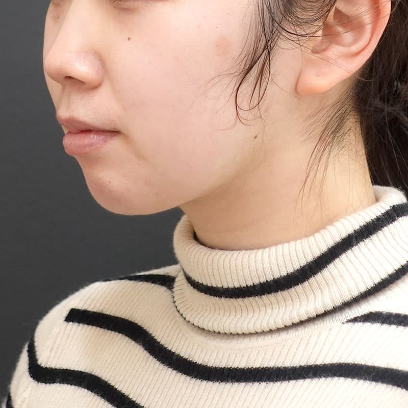 20241008_Fｰ1238_kaneko_face-liposuction_philtrum-botox②After