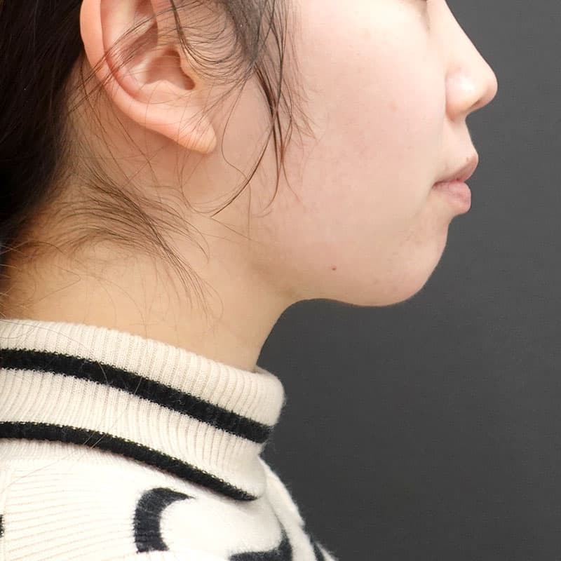 20241008_Fｰ1238_kaneko_face-liposuction_philtrum-botox③After