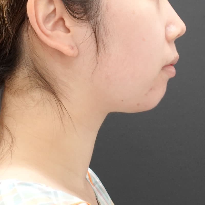 20241008_Fｰ1238_kaneko_face-liposuction_philtrum-botox③Before