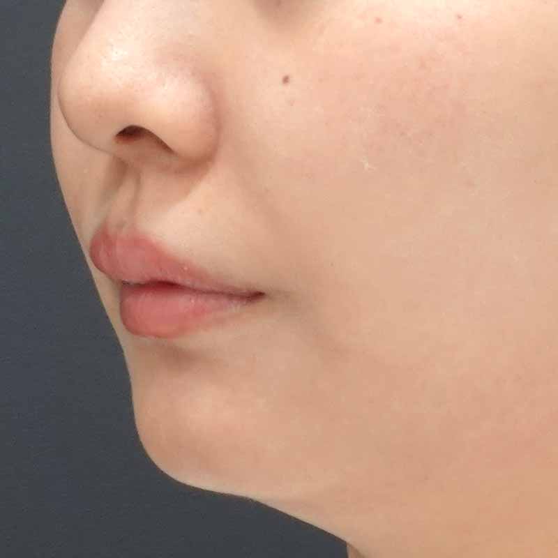 20241016_St202410162_tanaka_hyaluronic nasolabial folds①After