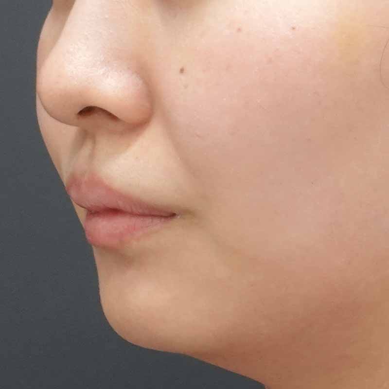 20241016_St202410162_tanaka_hyaluronic nasolabial folds①Before