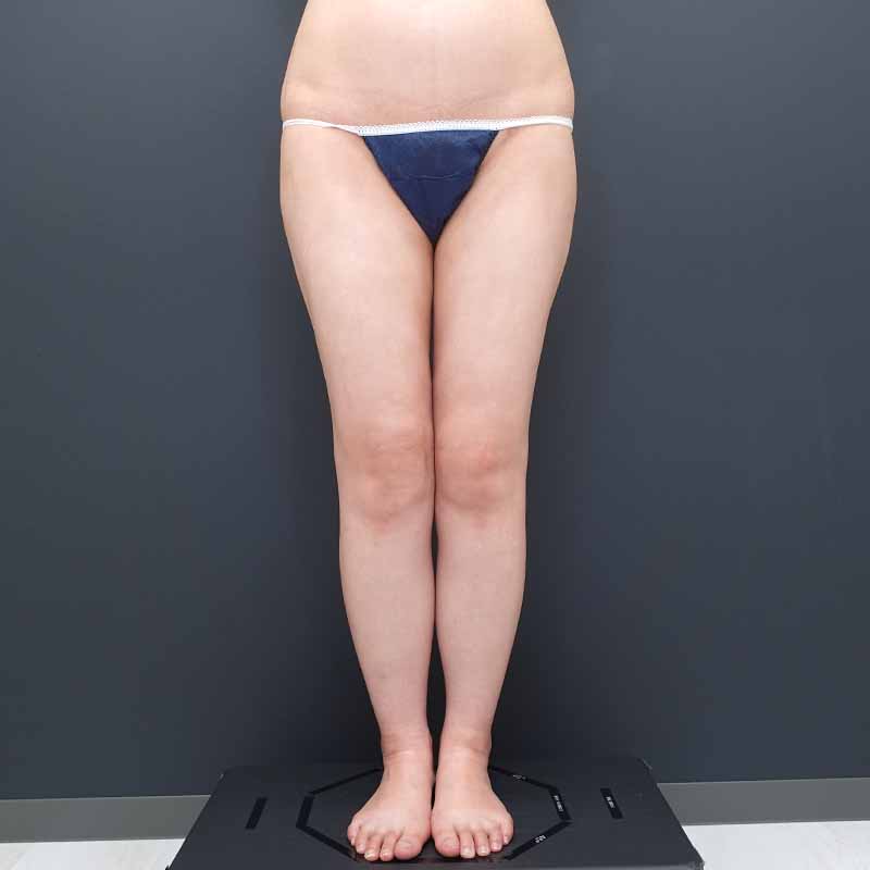 20241020_N50870_nisikawa_thigh-liposuction①After