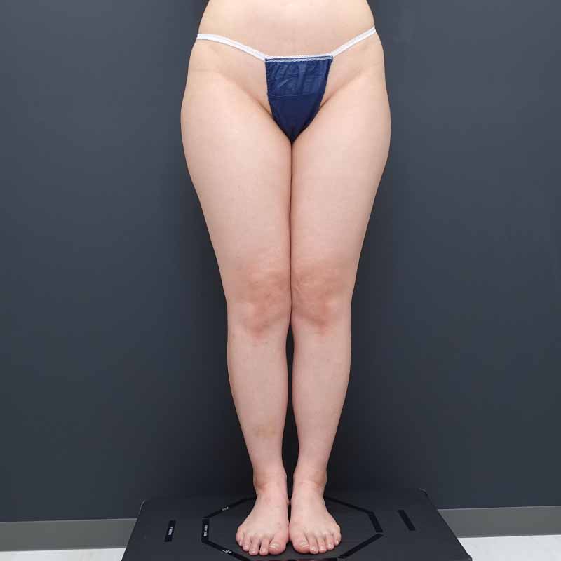 20241020_N50870_nisikawa_thigh-liposuction①Before