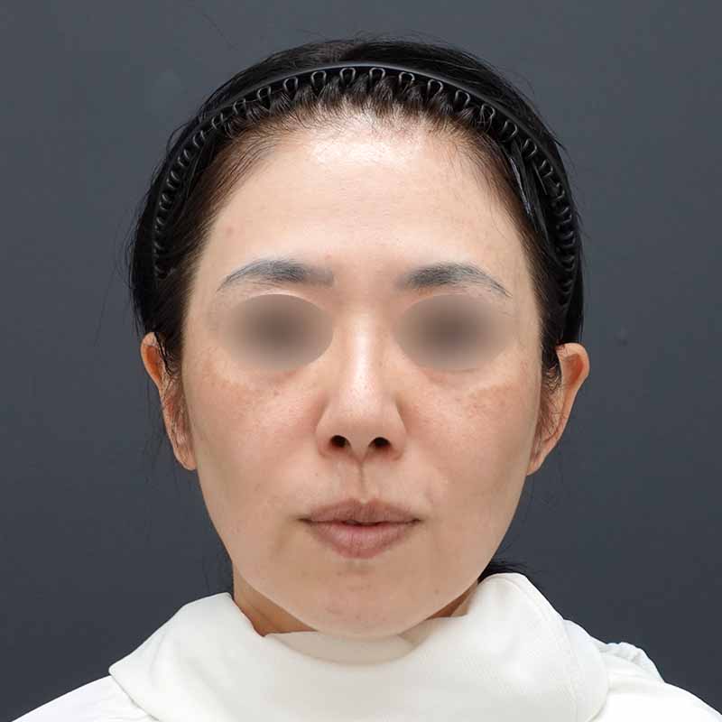 20241020_Ｎ104041_nisikawa_hyaluronic acid lift01①Before