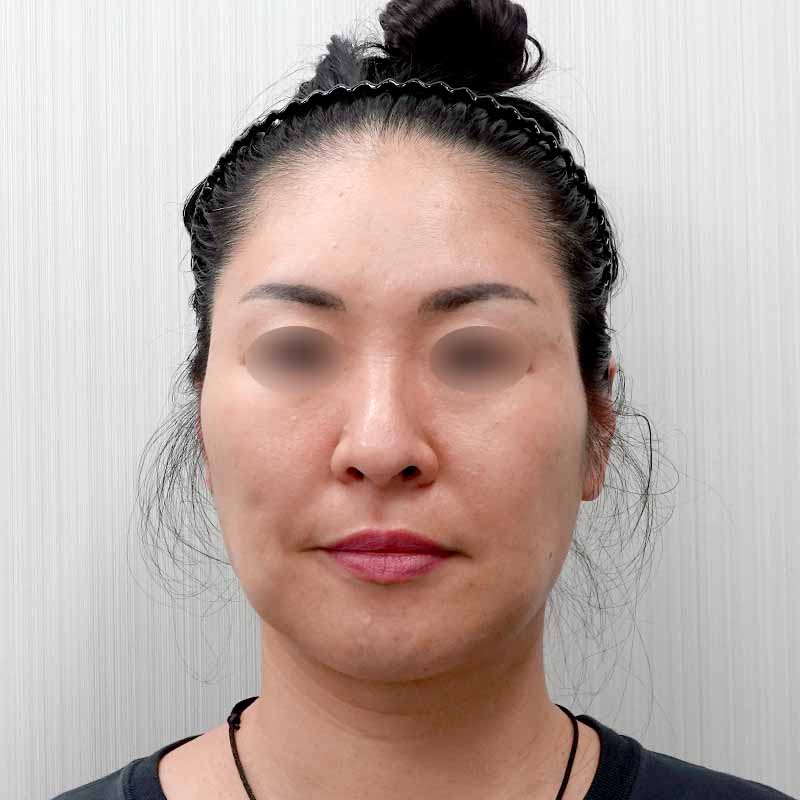 20241024_O-105476_sato_hyaluronic acid lift01①Before