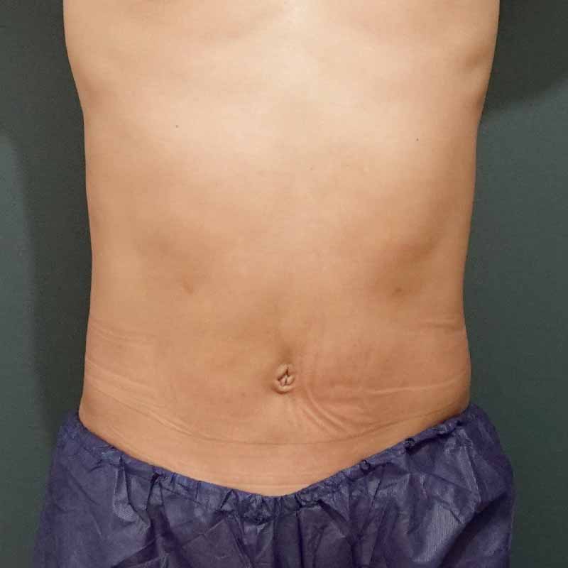 20241024_O35510_sato_stomach-liposuction①After