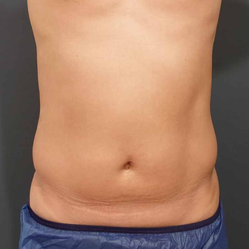 20241024_O35510_sato_stomach-liposuction①Before