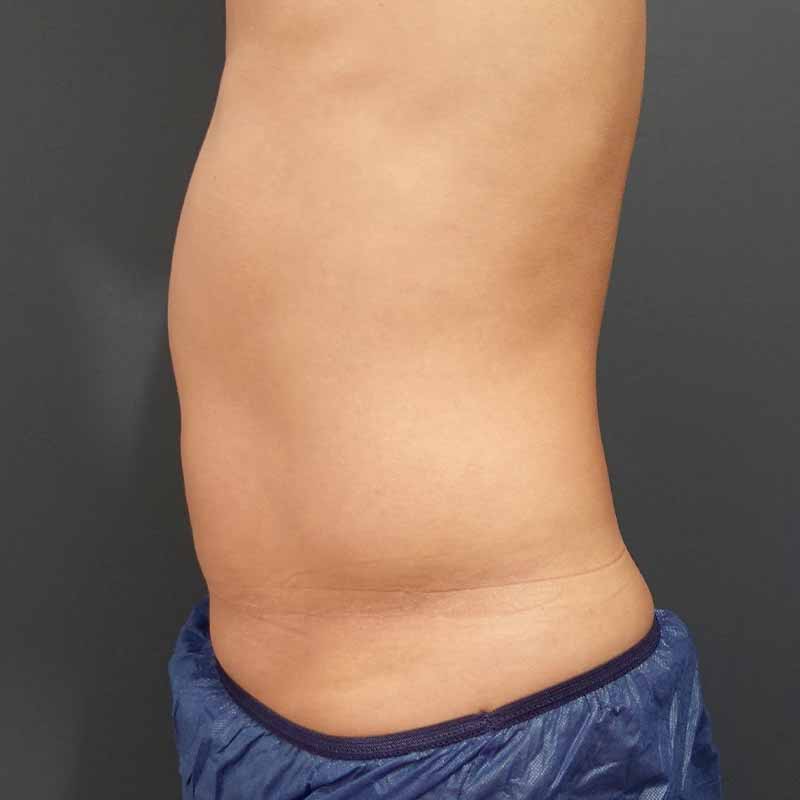 20241024_O35510_sato_stomach-liposuction②Before