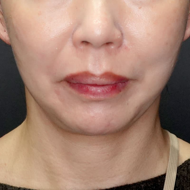 202401111_G34038_ishihara_Chin prosthesis②After