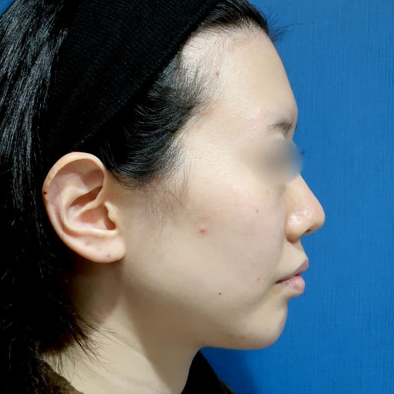 20241116_S12688_suzuki_face-liposuction①After