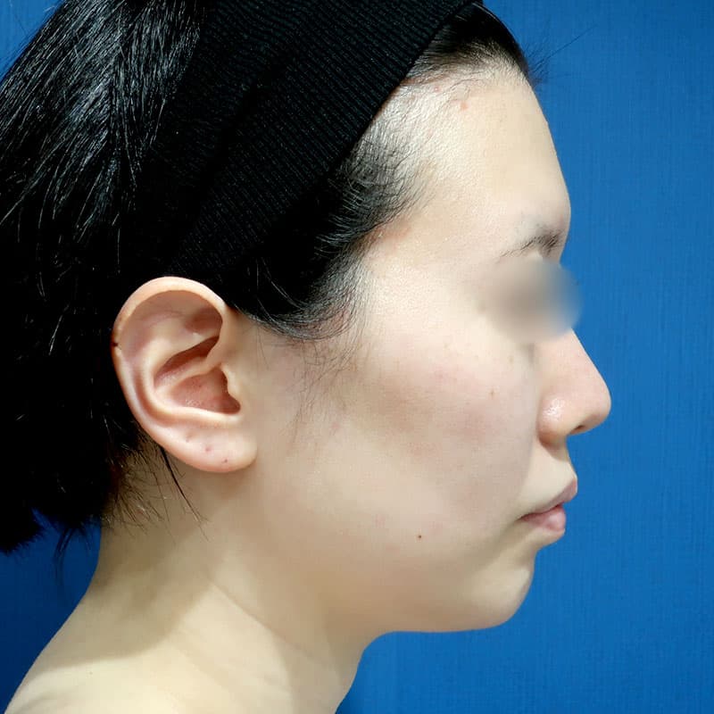 20241116_S12688_suzuki_face-liposuction①Before