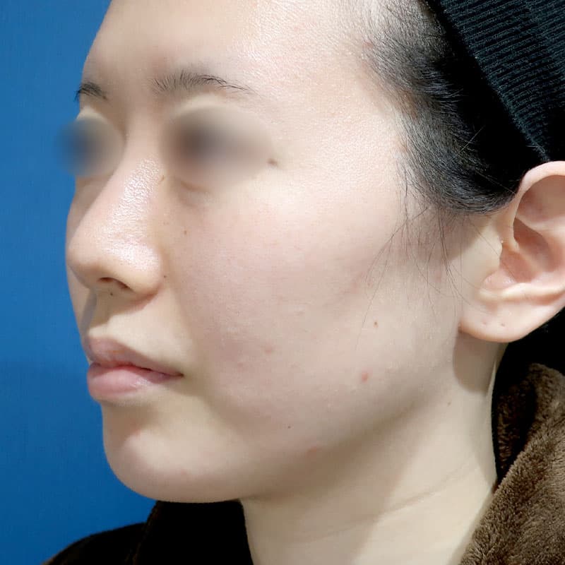 20241116_S12688_suzuki_face-liposuction②After