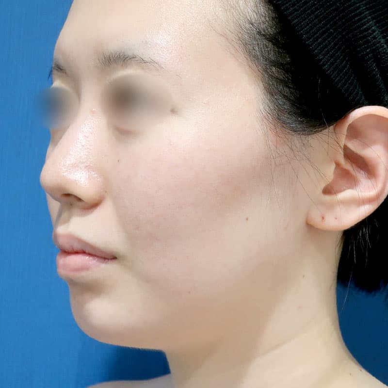 20241116_S12688_suzuki_face-liposuction②Before