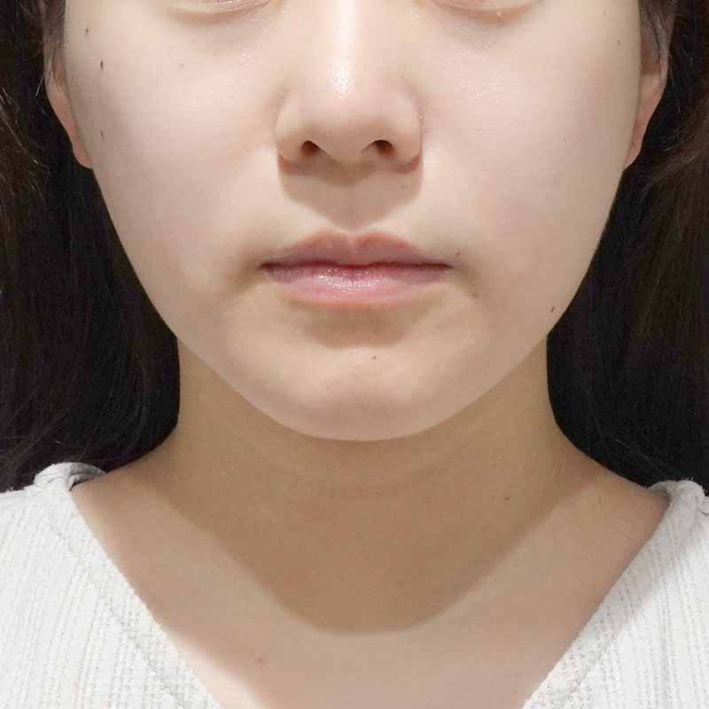 20241127_ G41248_furumura_face-liposuction_philtrum-botox①After