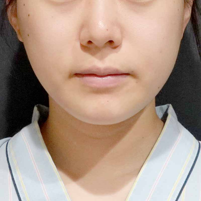 20241127_ G41248_furumura_face-liposuction_philtrum-botox①Before