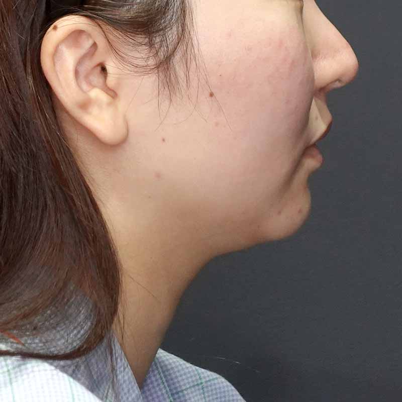 20241127_G38931_tukahara_face-liposuction_philtrum-botoxメイン横