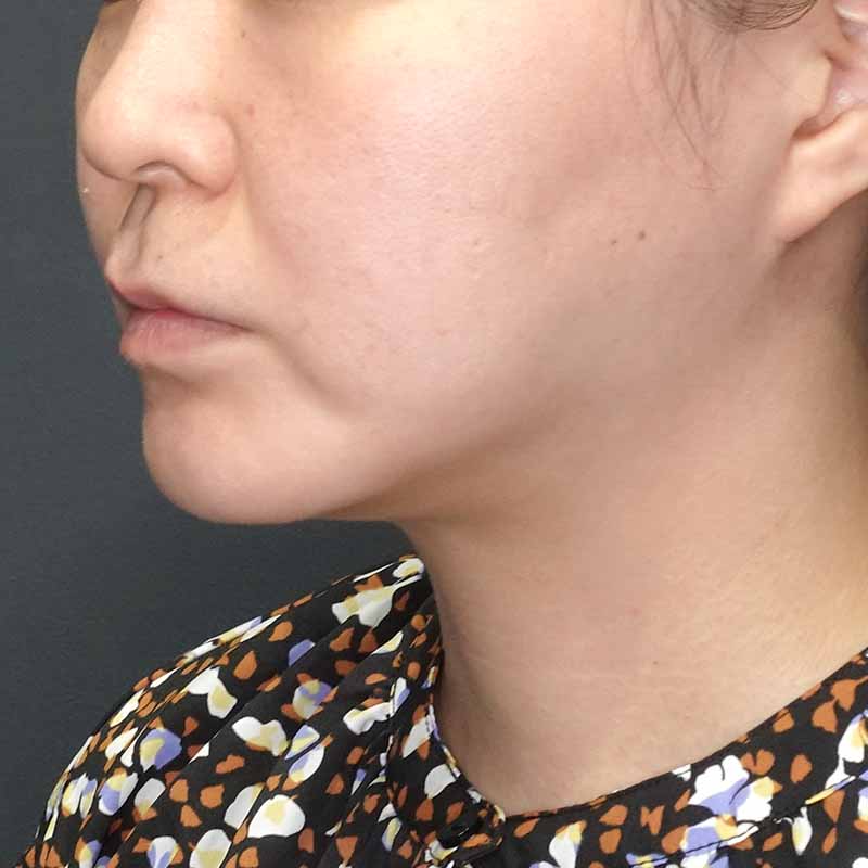 20241127_G40495_tukahara_face-liposuction_philtrum-botox①After