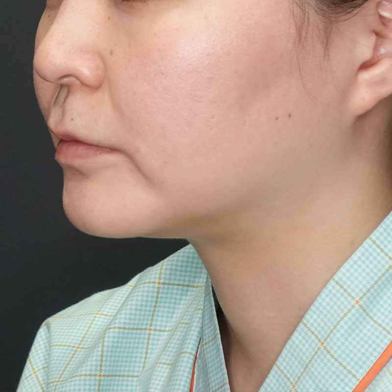 20241127_G40495_tukahara_face-liposuction_philtrum-botox①Before