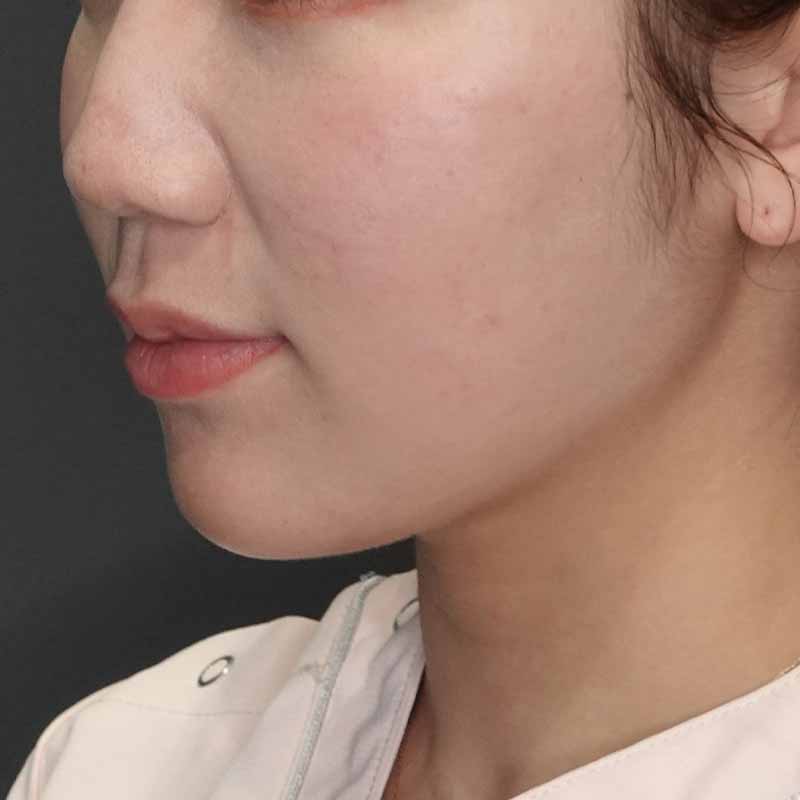 20241127_St20241127-2_tukahara_face-liposuction①Before