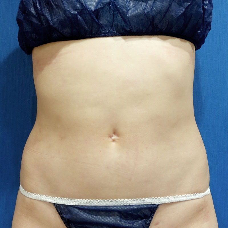 20241201_S18402_suzuki_stomach-liposuction①After