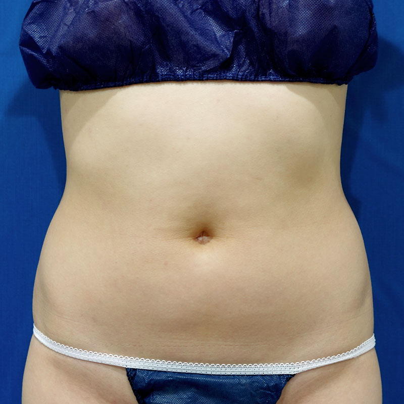 20241201_S18402_suzuki_stomach-liposuction①Before