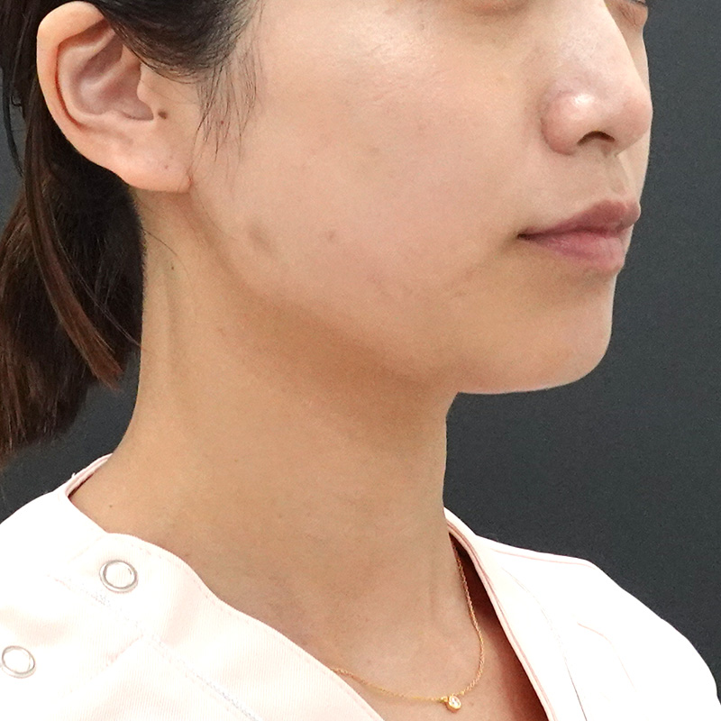 20241206_St20241206-7_nagahama_masseter-muscle_botox 斜めbefore