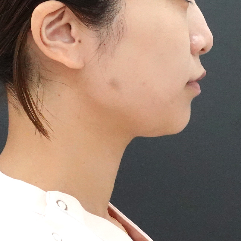 20241206_St20241206-7_nagahama_masseter-muscle_botox 横before