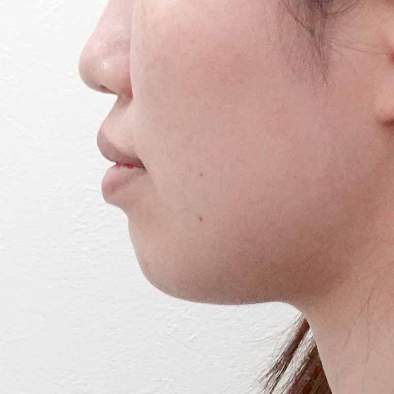 20241222_F103026_nagahama_hyaluronic jaw①Before