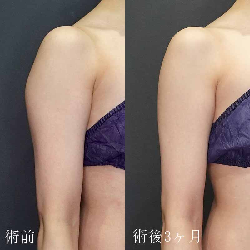 20241127_St20241127-5_tukahara_arm-liposuctionメイン縦